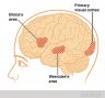 aphasia cortex